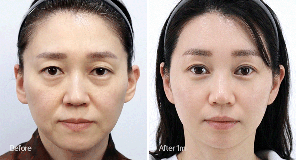 깊은 팔자주름