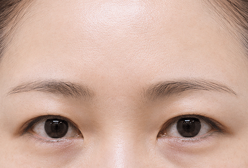 수술전 답답한 눈매와 묻힌 쌍꺼풀 라인